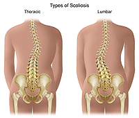 Illustration demonstrating thoracic and lumbar scoliosis