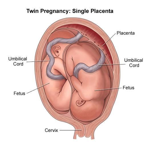 Illustration of a twin birth, head down/head down; 1 placenta, 2 cords