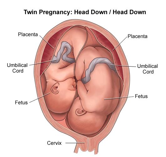 Illustration of a twin birth, head down/head down 