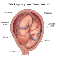 Illustration of a twin birth, head down/head up