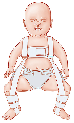 Baby in Pavlik harness.