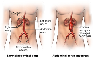 Aotra