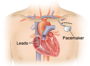 Replacing a pacemaker with a device the width of a human hair