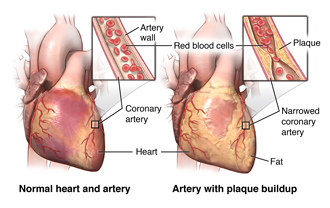 Normal heart and artery; artery with plaque buildup