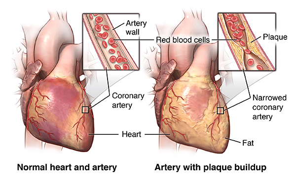 What are some healthy cardiovascular exercises to do after heart surgery?