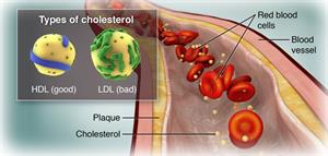 Types of cholesterol, HDL (good) and LDL (bad)