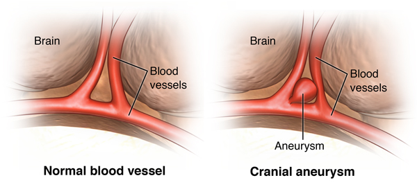 What are common signs of an aneurysm?