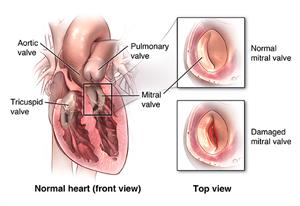 How do they treat a leaking heart valve?