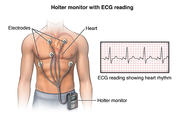 Holter Monitor Johns Hopkins Medicine Health Library Holter Monitor Johns Hopkins Medicine Health Library