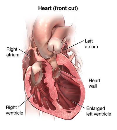 Right Heart Catheterization Health Encyclopedia University Of Rochester Medical Center