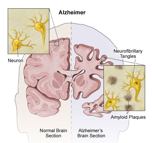 Alzheimer Disease - Health Encyclopedia - University of Rochester ...