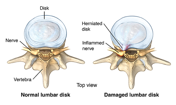 Low Back Pain Causes, Symptoms and Treatments