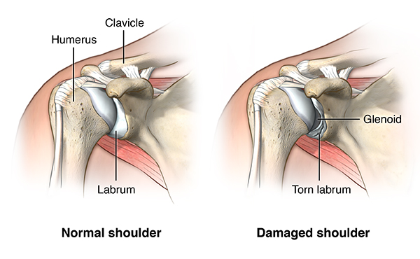 Shoulder Dislocation - Stanford Medicine Children's Health