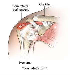 Broken rotator shop cuff