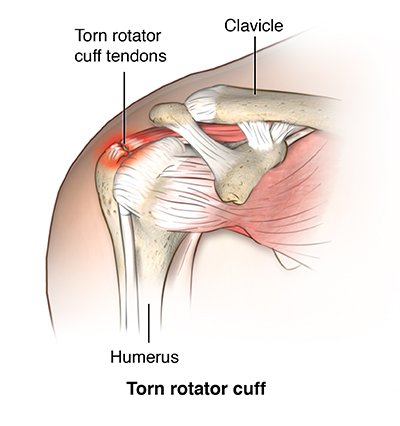 When should you get medical treatment for injured rotator cuff symptoms?