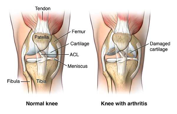 What happens in a total knee arthroplasty procedure?