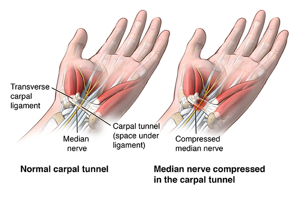 carpal tunnel self test