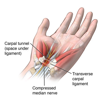 What is involved in a neurological nerve conduction test?