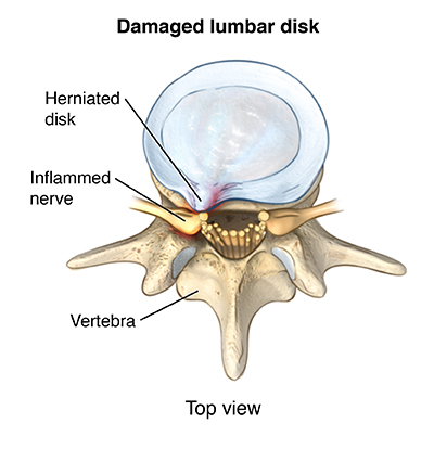 Sciatica &amp; Sciatica Treatment | U of U Health Care