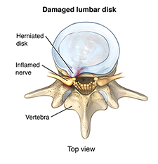 Damaged lumbar disk