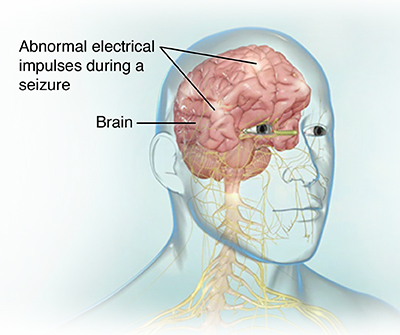 epilepsy brain waves