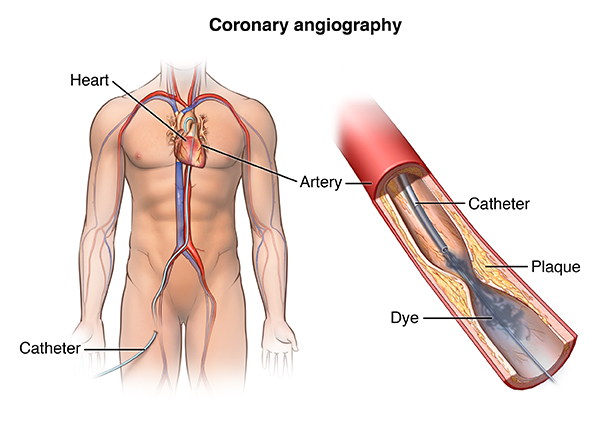 cardiac-catheterization-health-encyclopedia-university-of-rochester