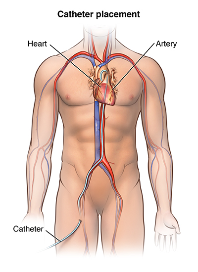 What is the average recovery time after a heart stent?