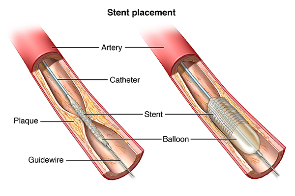 angioplasty-and-stent-placement-for-the-heart-health-encyclopedia