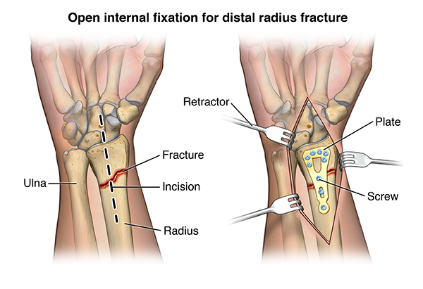 Bone Fractures: Types, Symptoms & Treatment