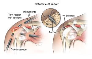 Rotator Cuff Repair - Pacific Orthopedics and Sports Medicine