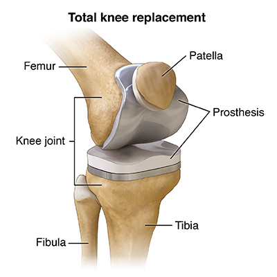 Knee Replacement Pictures 35