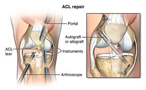 FUNCTIONAL ACL KNEE BRACE  Piedmont Medical Solutions