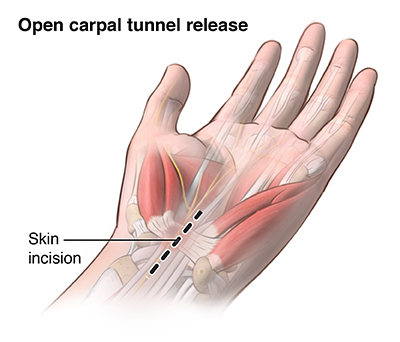 Carpal Tunnel Syndrome - Stanford Medicine Children's Health