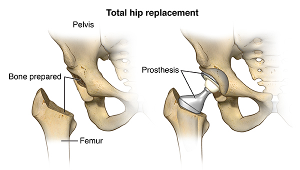 Total Hip Replacement in Atlanta, GA