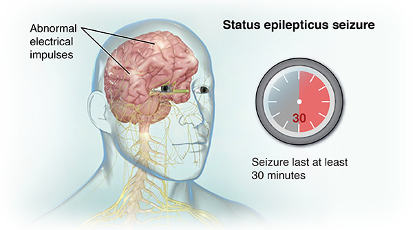 epilepsy brain damage