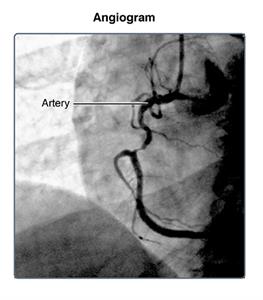 angiogram test heart Online Encyclopedia  Catheterization Cardiac Medical