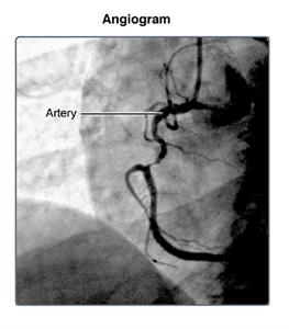 test angiogram heart Medical  Encyclopedia Cardiac  Online Catheterization