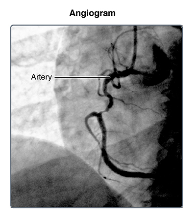 heart dye with test Catheterization  Johns  Cardiac Medicine Hopkins Health