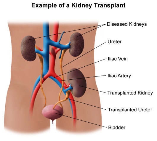 kidney transplant diagram