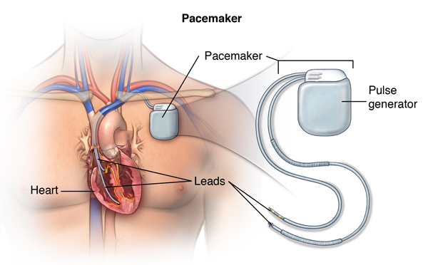 Replacing a pacemaker with a device the width of a human hair