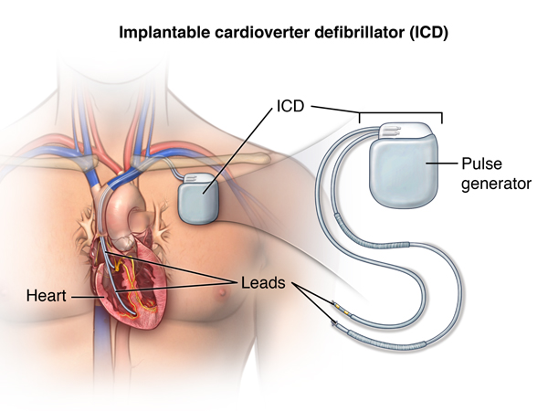 Overview Of Pacemakers And Implantable Cardioverter Defibrillators Icds Health Encyclopedia University Of Rochester Medical Center