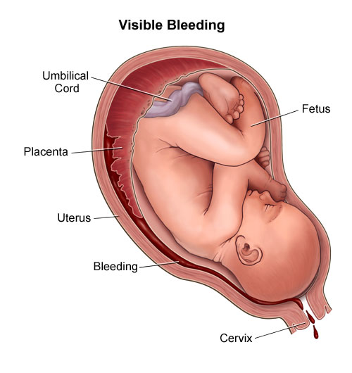 Complications of Pregnancy - Stanford Medicine Children's Health