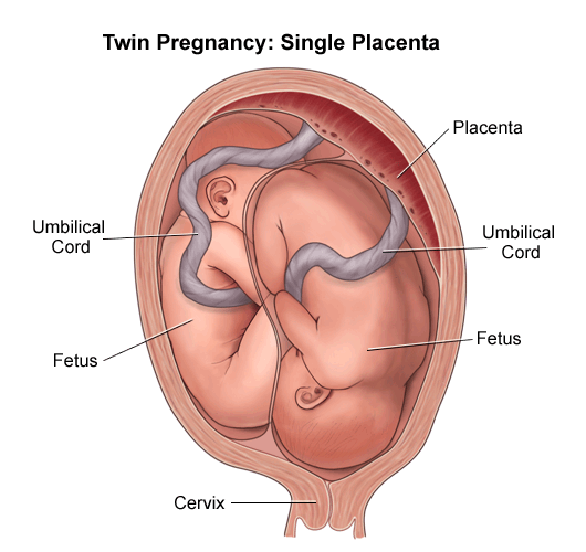 amniotic sac diagram