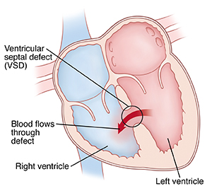 Four-chamber view of heart showing ventricular septal defect.