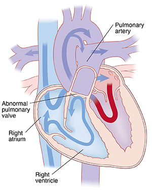 Four-chamber view of heart showing pulmonary atresia. Arrows indicate blood unable to flow from right ventricle to pulmonary artery.