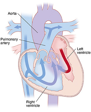 Four-chamber view of heart showing double outlet right ventricle. Arrows indicate blood flowing from right ventricle to pulmonary artery and aorta.
