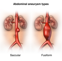 Different types of aortic anerysms