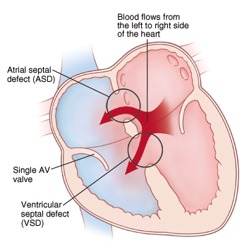 Front view cross section of heart showing atrial septal defect (ASD) in septum between atria. and ventricular septal defect (VSD) in septum between ventricles. There is only one AV valve. Arrows show blood flowing from left to right side of heart.