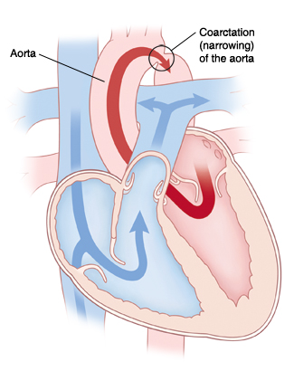 Four-chamber view of heart showing  coarctation of the aorta. Arrows indicate blood flow restricted in aorta. 