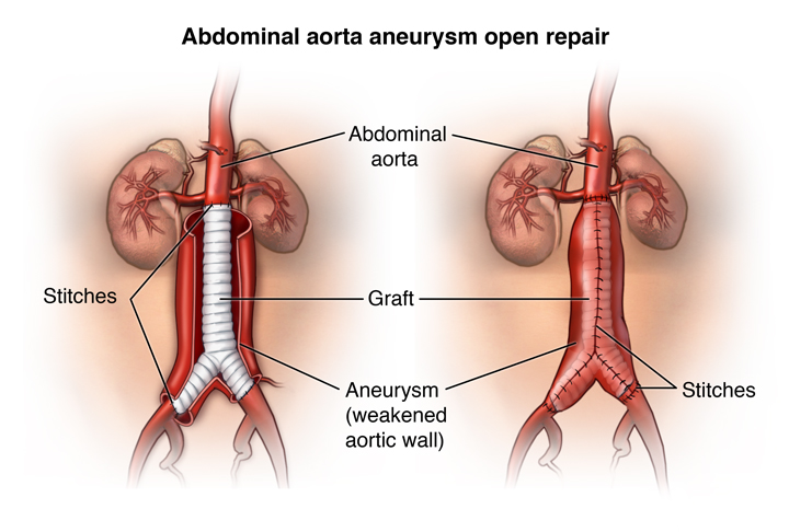 Aorta Aneurysm Causes